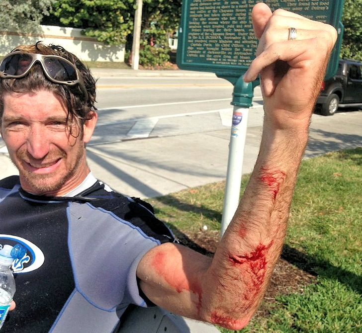 Kurt Hoffman: bitten by a Floridian shark