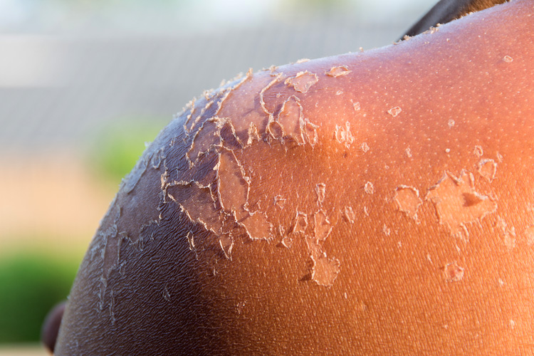 Skin cancer: the only type of cancer that you can prevent | Photo: Shutterstock