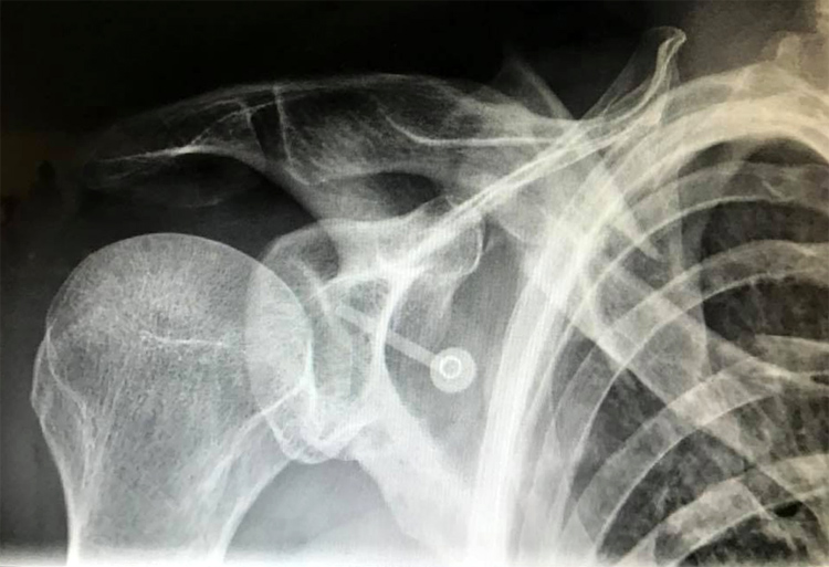 Pat Caldwell's collarbone: he broke for the second time | Photo: JJ Caldwell