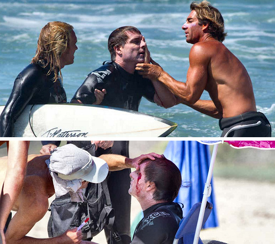 Chris Owen: surf injuries mean blood
