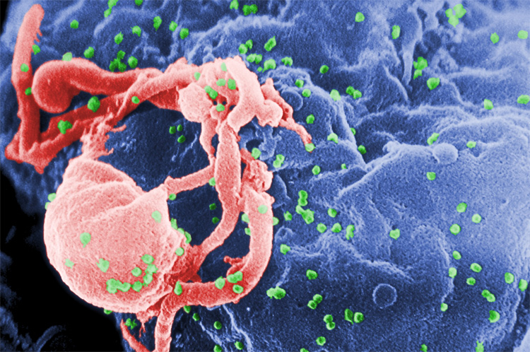 HIV/AIDS: clinically reported for the first time in the United States on June 5, 1981 | Photo: Creative Commons