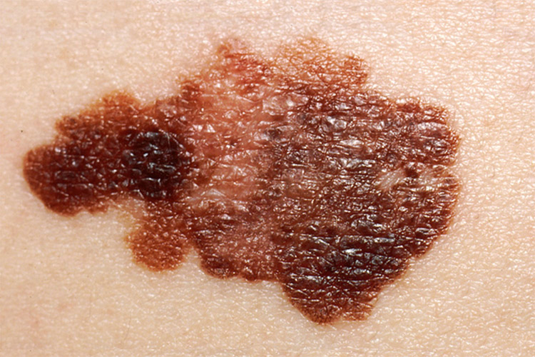 Melanoma: the deadliest form of skin cancer | Photo: Creative Commons