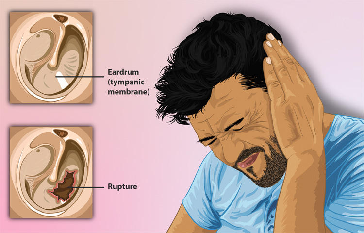 Perforated eardrum: the rupture of the tympanic membrane causes a lot of pain | Illustration: Creative Commons
