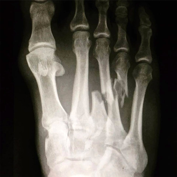 Kelly Slater's broken foot: he will need between four to six months to make a full recovery | Photo: Kelly Slater
