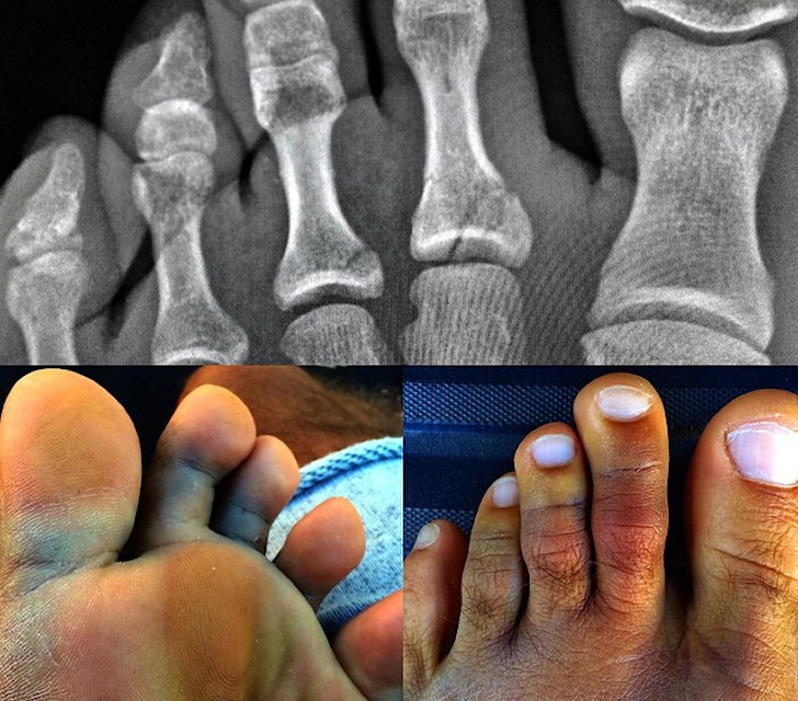 Kelly Slater: broken toes, not broken dreams | Photo: Kelly Slater