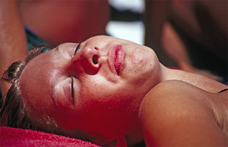 Sunburn: the easiest way to develop skin cancer | Photo: Creative Commons