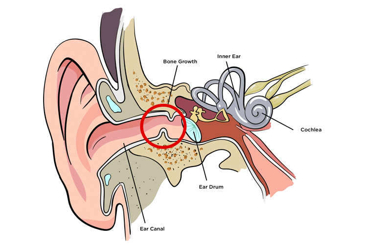 Surfer's ear: abnormal growth of bone in the ear canal can only be stopped with ear plugs | Illustration: SurfEars