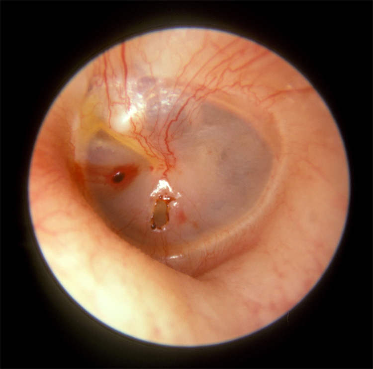 Perforation of the tympanic membrane: a condition that often requires surgery | Photo: Creative Commons